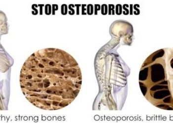 Hindari Makanan berikut untuk Cegah Osteoporosis