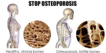 Hindari Makanan berikut untuk Cegah Osteoporosis
