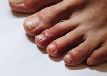 Gejala COVID-19 Bisa Terlihat dari Ruam Kulit, Ini Penjelasannya